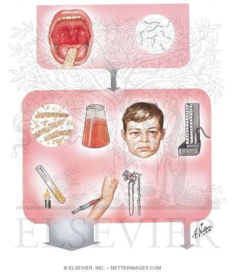 Acute Glomerulonephritis