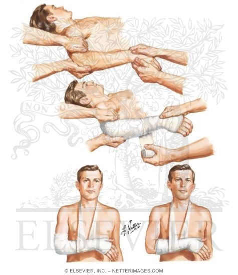 Traction Reduction of Colles' Fracture