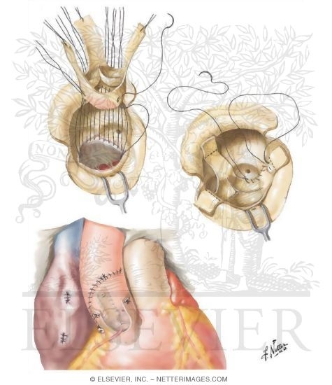 Aortic-Valve Homograft