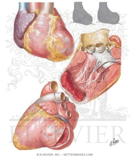 Watermarked preview of unlabeled image: Arteriosclerotic Heart Disease