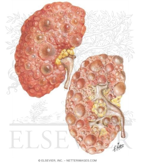 Watermarked preview of unlabeled image: Renal Cystic Diseases