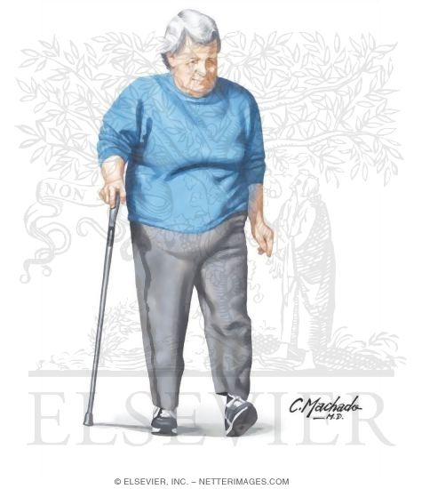 Overweight Woman With Cane