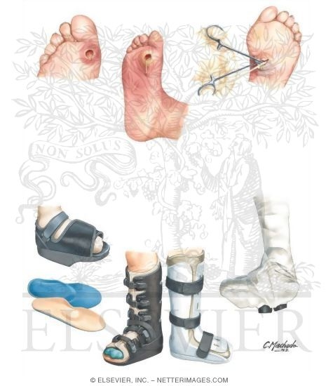 Watermarked preview of unlabeled image: Diagnosis and Treatment of Ulcer Infections