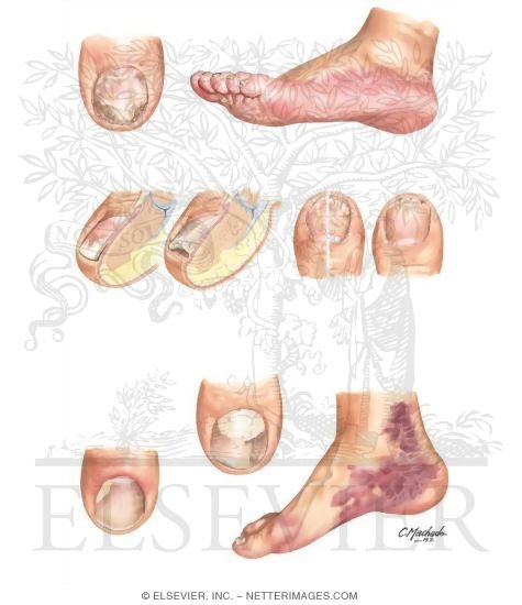 Clinical Examples of Onychomycosis