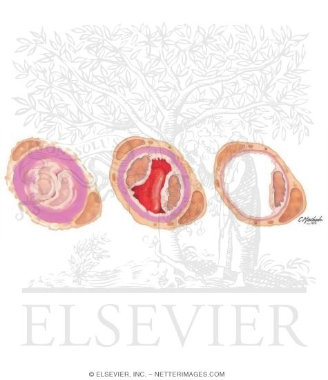 Watermarked preview of unlabeled image: Capillary Occluded by Diabetes