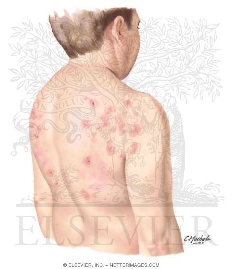 Watermarked preview of unlabeled image: Dermatitis herpetiformis