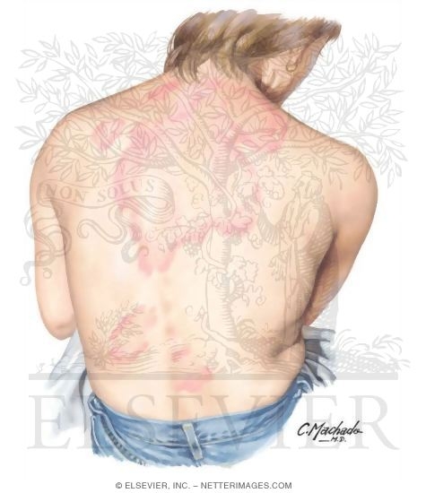 Tinea Corporis