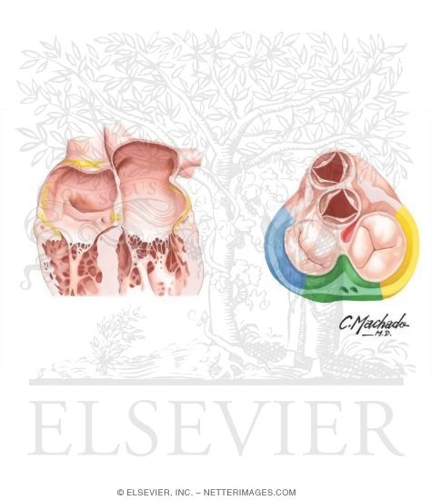 Watermarked preview of unlabeled image: Location of Atrioventricular Accessory Pathways and Classification