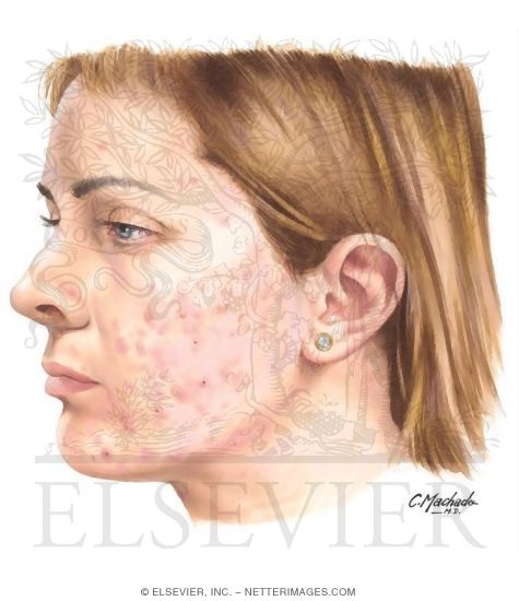 Watermarked preview of unlabeled image: Acne Vulgaris