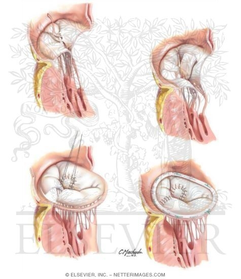 Watermarked preview of unlabeled image: Chordal Transfer, Sliding Annuloplasty, and Ring Annuloplasty