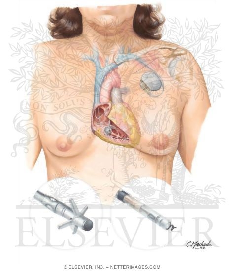 Watermarked preview of unlabeled image: Implantable Cardiac Pacemaker (Dual-Chamber Cardiac Pacing)