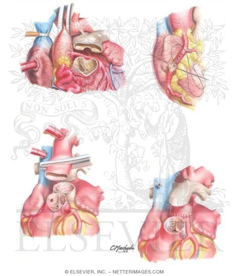 Watermarked preview of unlabeled image: Arterial Repair of Transposition of the Great Arteries
Surgical Procedures for Correction of Congenital Coronary Artery Anomalies
