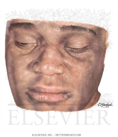 Watermarked preview of unlabeled image: Pityriasis Alba
