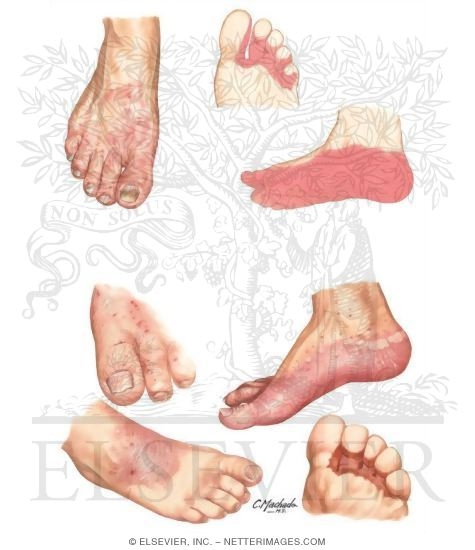 Watermarked preview of unlabeled image: Diagnosis of Tinea Pedis