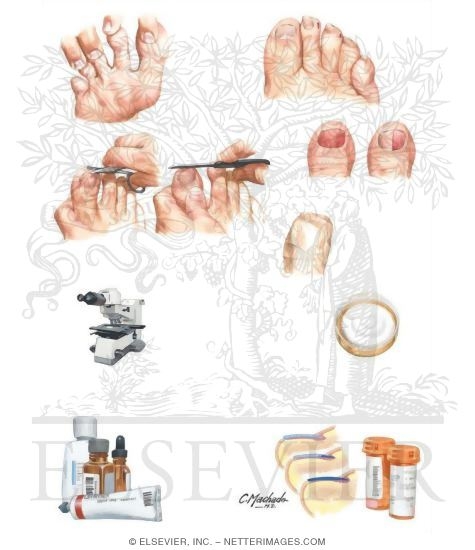 Watermarked preview of unlabeled image: Prevention and Management of Onychomycosis