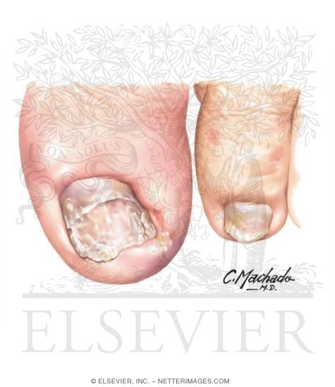 Onychomycosis and Paronychia