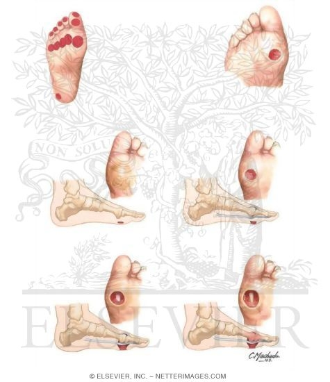 Watermarked preview of unlabeled image: Clinical Presentation and Classification of Ulcers