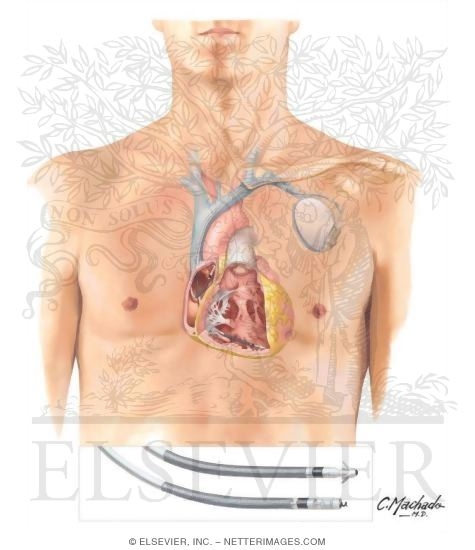 Watermarked preview of unlabeled image: Implantable Cardiac Defibrillator (Dual-Chamber Leads)