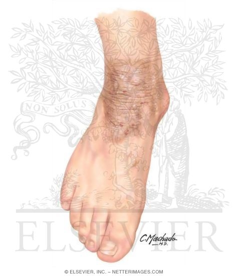 Lichen Simplex (Neurodermatitis)