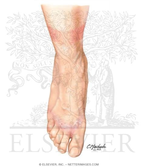 Watermarked preview of unlabeled image: Contact Dermatitis
