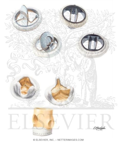 Watermarked preview of unlabeled image: Second Generation of Synthetic Prosthetic Valves and Biologic Valves