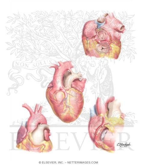 Watermarked preview of unlabeled image: Congenital Coronary Artery Anomalies