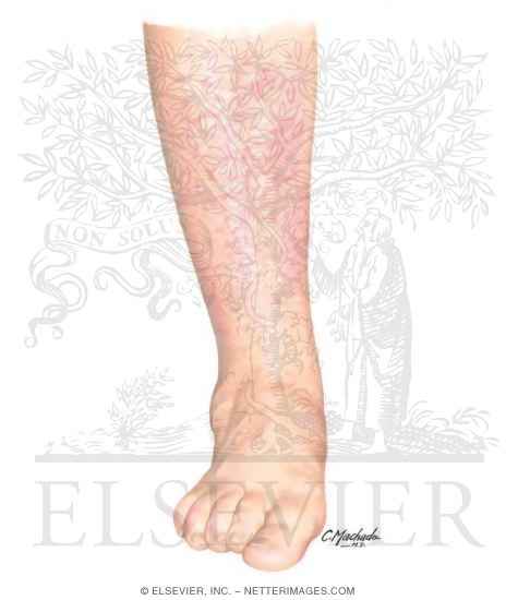 Asteatotic Eczema