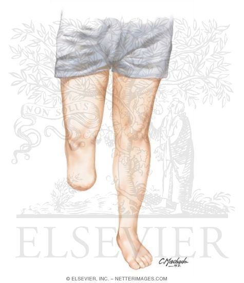 Watermarked preview of unlabeled image: Leg Amputation