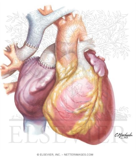 Watermarked preview of unlabeled image: Tricuspid Atresia