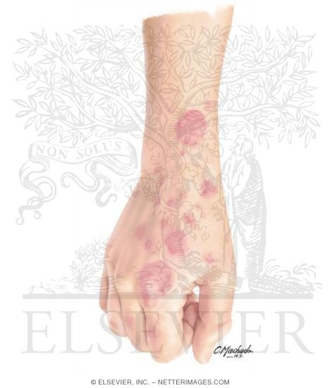 Nummular Eczema