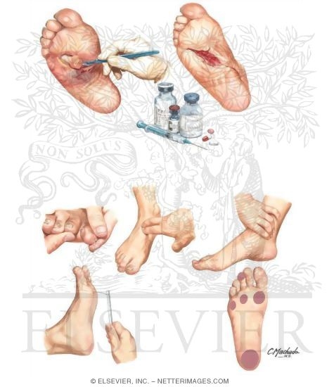 Watermarked preview of unlabeled image: Treatment, Prevention and Screening of Malperforans