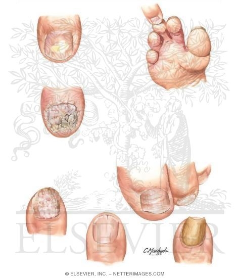 Watermarked preview of unlabeled image: Clinical Examples of Onychomycosis