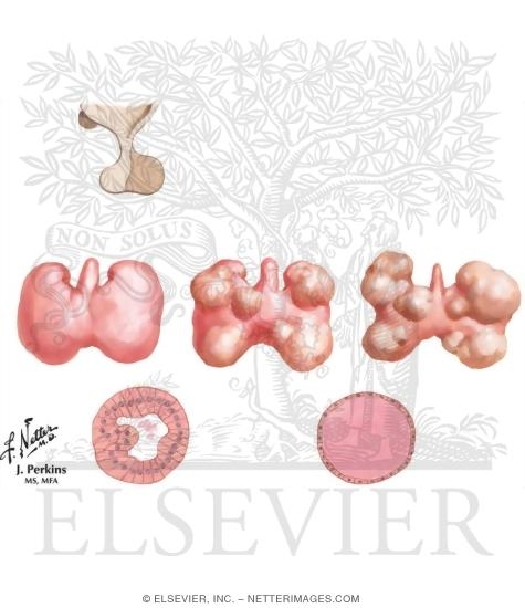 Watermarked preview of unlabeled image: Etiology of Nontoxic Goiter