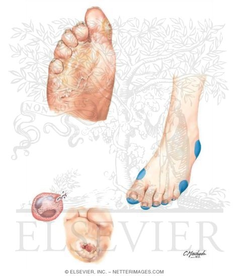 Watermarked preview of unlabeled image: Factors Predisposing to Foot Ulcers (Autonomic)