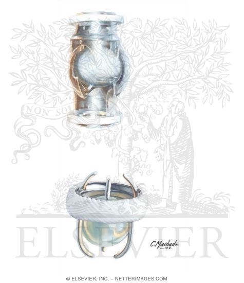 Watermarked preview of unlabeled image: First Generation of Synthetic Prosthetic Valves