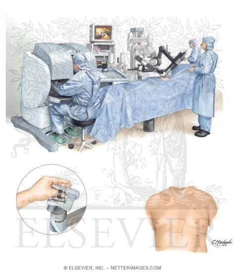 Watermarked preview of unlabeled image: Remote-Access Minimally Invasive Coronary Artery Bypass Grafting