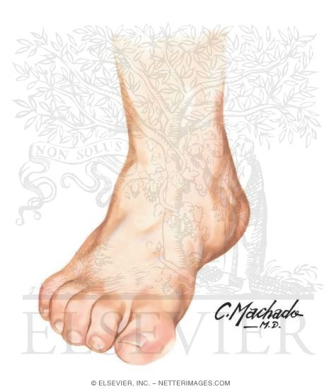 Watermarked preview of unlabeled image: Foot: Diminished Circulation