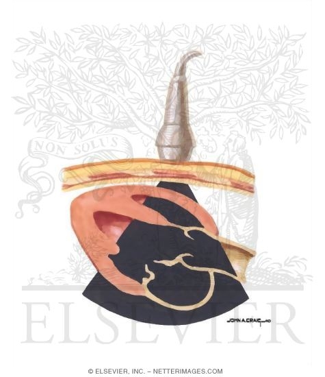 Watermarked preview of unlabeled image: Mitral Regurgitation