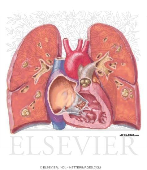 Watermarked preview of unlabeled image: Substance Abuse and the Heart