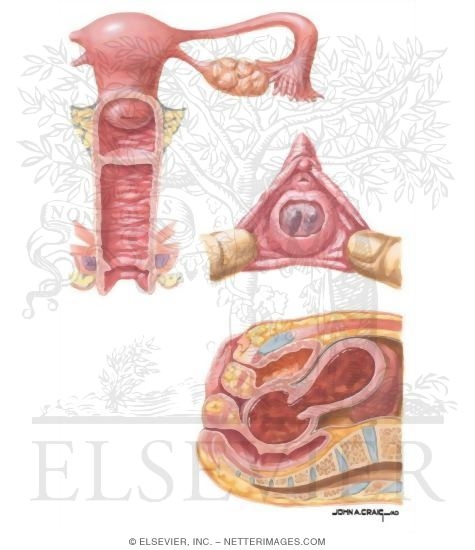 Transverse Vaginal Septum