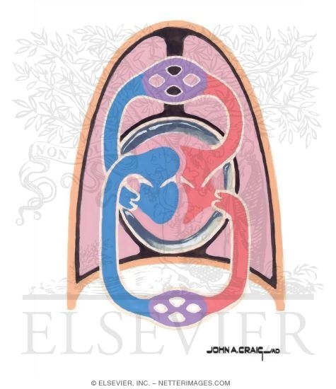 Watermarked preview of unlabeled image: Cardiac Tamponade (Inspiration)