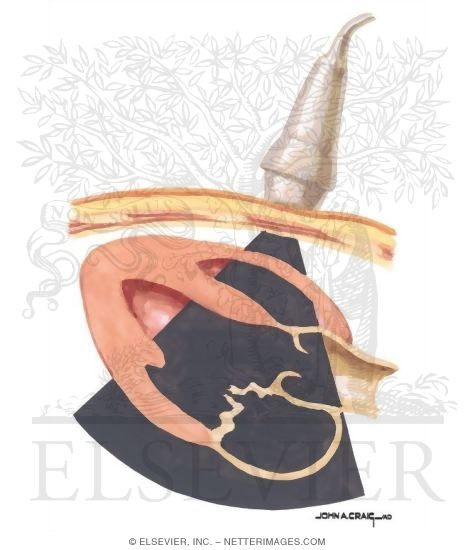 Watermarked preview of unlabeled image: Mitral Stenosis