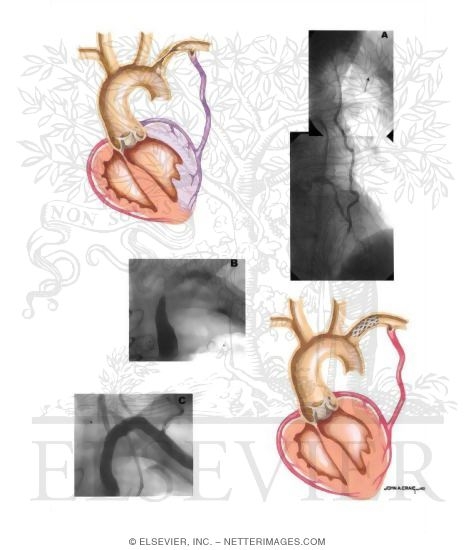 Watermarked preview of unlabeled image: Angiographic Demonstration of Subclavian Steal