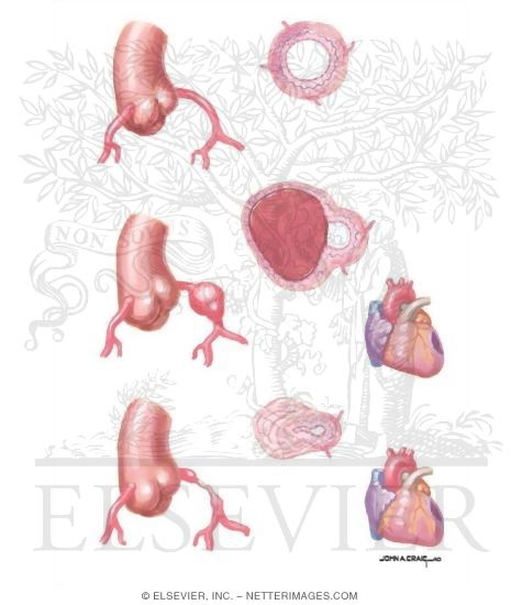 Watermarked preview of unlabeled image: Pathogenesis and Clinical Course of Kawasaki Disease