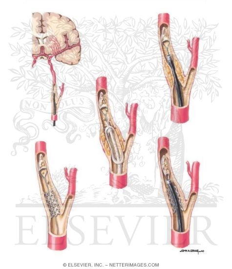 Watermarked preview of unlabeled image: Cerebrovascular Emboli Protection Device