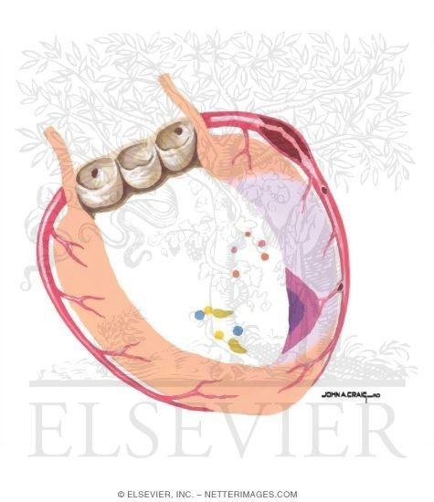 Watermarked preview of unlabeled image: Acute Coronary Syndromes: Plaque Formation