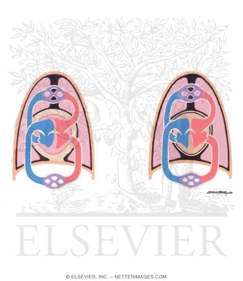 Watermarked preview of unlabeled image: Constrictive Pericarditis and Restrictive Cardiomyopathy Inspiration