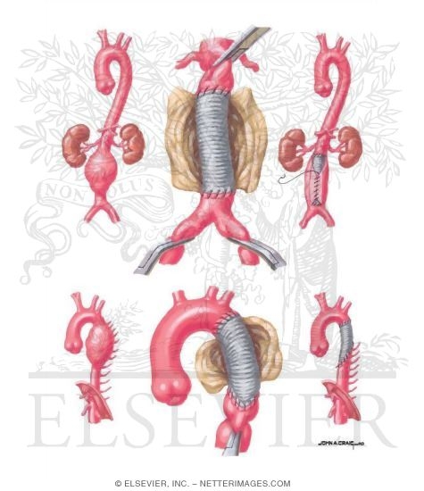Watermarked preview of unlabeled image: Surgical Management of Aortic Aneurysms