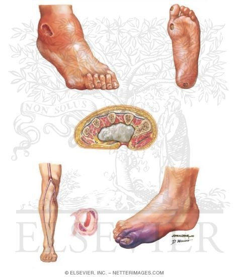Watermarked preview of unlabeled image: Lesions in Diabetic Foot
