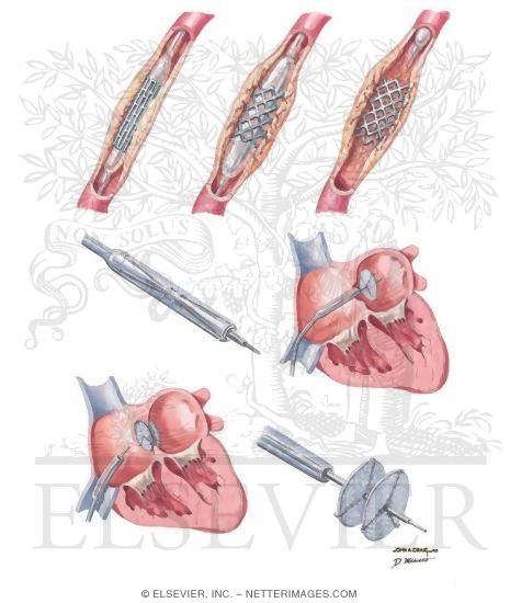 Watermarked preview of unlabeled image: Interventional Approaches to Peripheral Arterial Disease
